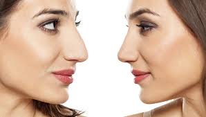 rhinoplastie Tunisie