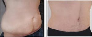 abdominoplastie homme tunisie