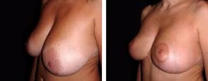 Photos avant/après Lifting seins