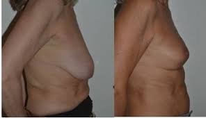 Photos avant et après Lifting seins