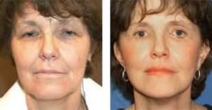 Photos avant/après Lifting Visage