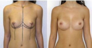 Augmentation mammaire avec prothèses avant apres