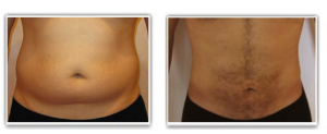 abdominoplastie