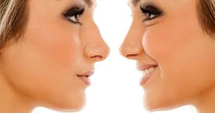 rhinoplastie medicale vs rhinoplastie classique