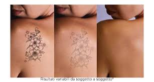 detatouage laser tunisie