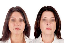 resultat injection prp tunisie