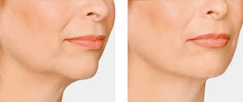 résultat mini lifting visage