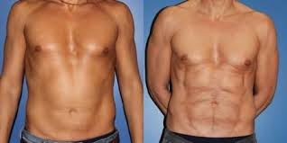 abdominal etching avant apres