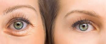 Photos avant/après Blépharoplastie  Clinique PCE en Tunisie