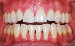 poche gingivale