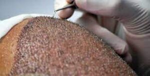implant cheveux
